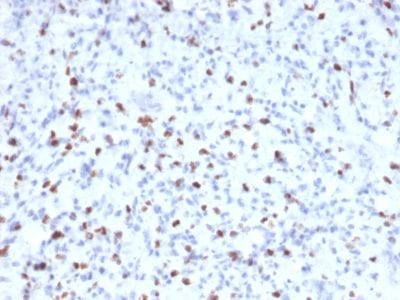Formalin-fixed paraffin-embedded human Rhabdomyosarcoma stained with Myogenin Mouse Monoclonal Antibody (MYOG/2660)