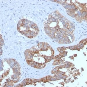 Formalin-fixed paraffin-embedded human Prostate Carcinoma stained with MUC1 Recombinant Rabbit Monoclonal Antibody (MUC1/2729R).