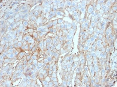 Formalin-fixed, paraffin-embedded human Cervical Carcinoma stained with PD-L1 Mouse Monoclonal Antibody (PDL1/2746).