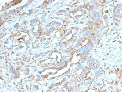 Formalin-fixed, paraffin-embedded human Breast Carcinoma stained with PD-L1 Mouse Monoclonal Antibody (PDL1/2746).