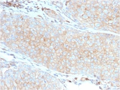 Formalin-fixed, paraffin-embedded human Basal Cell Carcinoma stained with PD-L1 Mouse Monoclonal Antibody (PDL1/2746).