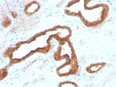 Formalin-fixed paraffin-embedded human Renal Cell Carcinoma stained with AMACR Recombinant Rabbit Monoclonal Antibody (AMACR/2748R).