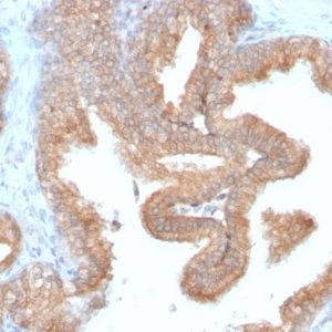 Formalin-fixed paraffin-embedded human Prostate Carcinoma stained with AMACR Recombinant Rabbit Monoclonal Antibody (AMACR/2748R).