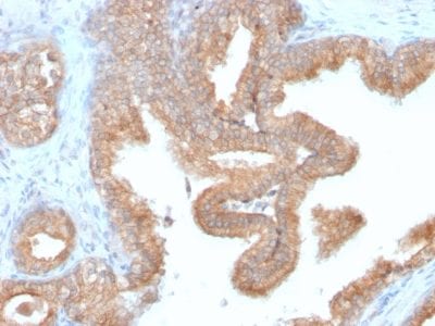Formalin-fixed paraffin-embedded human Prostate Carcinoma stained with AMACR Recombinant Rabbit Monoclonal Antibody (AMACR/2748R).