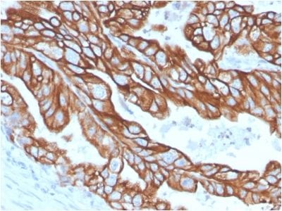 Formalin-fixed paraffin-embedded human Colon Carcinoma stained with CK18 Rabbit Recombinant Monoclonal Antibody (KRT18/2808R).