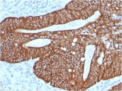 Formalin-fixed paraffin-embedded human Colon Carcinoma stained with CK18 Rabbit Recombinant Monoclonal Antibody (KRT18/2808R).