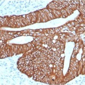 Formalin-fixed paraffin-embedded human Colon Carcinoma stained with Cytokeratin 18 Rabbit Recombinant Monoclonal Antibody (KRT18/2819R).