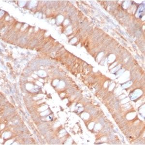 Formalin-fixed paraffin-embedded human Colon Carcinoma stained with CD59 Rabbit Recombinant Monoclonal Antibody (MACIF/2867R).