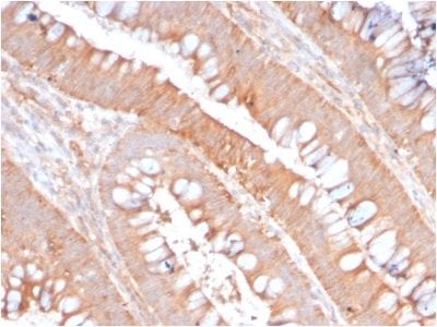 Formalin-fixed paraffin-embedded human Colon Carcinoma stained with CD59 Rabbit Recombinant Monoclonal Antibody (MACIF/2867R).