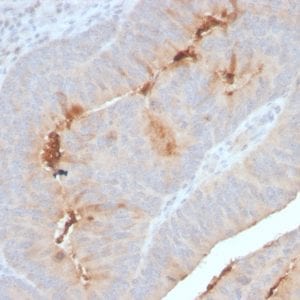 Formalin-fixed paraffin-embedded human Colon Carcinoma stained with Serum Amyloid A Recombinant Rabbit Monoclonal Antibody (SAA/2868R).