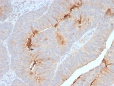 Formalin-fixed paraffin-embedded human Colon Carcinoma stained with Serum Amyloid A Recombinant Rabbit Monoclonal Antibody (SAA/2868R).