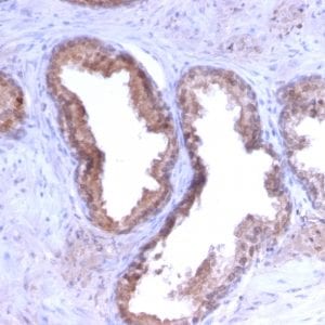 Formalin-fixed paraffin-embedded human Prostate Carcinoma stained with PSA Rabbit Recombinant Monoclonal Antibody (KLK3/2871R).