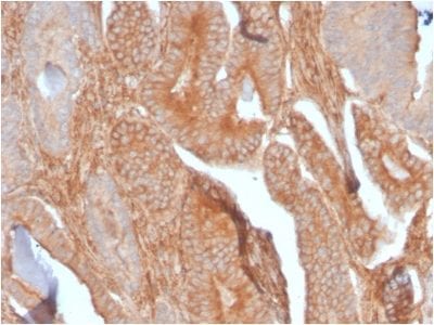 Formalin-fixed paraffin-embedded human Prostate Carcinoma stained with CD81 Rabbit Recombinant Monoclonal Antibody (C81/2885R).
