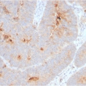Formalin-fixed paraffin-embedded human Colon Carcinoma stained with Secretory Component Rabbit Recombinant Monoclonal (ECM1/2889R).