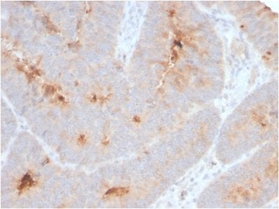 Formalin-fixed paraffin-embedded human Colon Carcinoma stained with Secretory Component Rabbit Recombinant Monoclonal (ECM1/2889R).