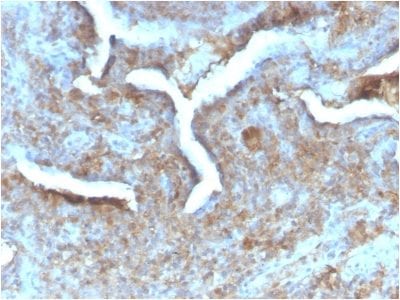 Formalin-fixed paraffin-embedded human Prostate Carcinoma stained with Thymidine Phosphorylase Rabbit Recombinant Monoclonal (TYMP/2890R).