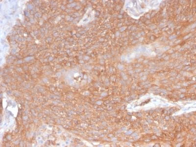 Formalin-fixed paraffin-embedded human Pancreatic Cancer stained with Spectrin beta III Rabbit Recombinant Monoclonal (SPTBN2/2894R).