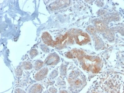 Formalin-fixed paraffin-embedded human Breast Carcinoma stained with Major Vault Protein Rabbit Recombinant Monoclonal Antibody (VP2897R).