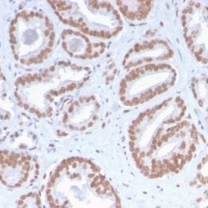 Formalin-fixed paraffin-embedded human Prostate Carcinoma stained with ATRX Rabbit Recombinant Monoclonal Antibody (ATRX/2900R).