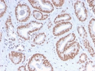 Formalin-fixed paraffin-embedded human Prostate Carcinoma stained with ATRX Rabbit Recombinant Monoclonal Antibody (ATRX/2900R).