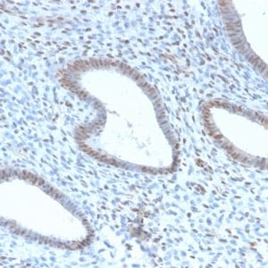 Formalin-fixed paraffin-embedded Human Endometrial Carcinoma stained with TLE1 Rabbit Recombinant Monoclonal Antibody (TLE1/2946R).