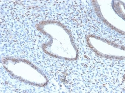 Formalin-fixed paraffin-embedded Human Endometrial Carcinoma stained with TLE1 Rabbit Recombinant Monoclonal Antibody (TLE1/2946R).