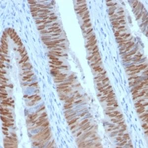 Formalin-fixed paraffin-embedded human Colon Carcinoma stained with CDX2 Rabbit Recombinant Monoclonal Antibody (CDX2/2951R).