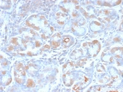Formalin-fixed paraffin-embedded human Stomach Carcinoma stained with pS2 Rabbit Recombinant Monoclonal Antibody (TFF1/2969R).