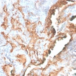 Formalin-fixed paraffin-embedded human Lung Carcinoma stained with Tenascin C Rabbit Recombinant Monoclonal Antibody (TNC/2981R).