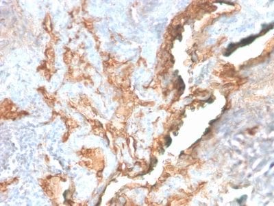 Formalin-fixed paraffin-embedded human Lung Carcinoma stained with Tenascin C Rabbit Recombinant Monoclonal Antibody (TNC/2981R).