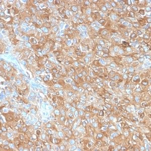 Formalin-fixed paraffin-embedded human Prostate Carcinoma stained with CD63 Rabbit Recombinant Monoclonal Antibody (LAMP3/2990R).