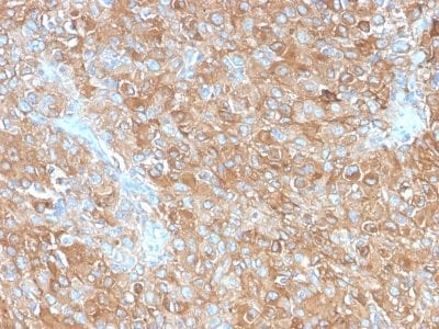 Formalin-fixed paraffin-embedded human Prostate Carcinoma stained with CD63 Rabbit Recombinant Monoclonal Antibody (LAMP3/2990R).