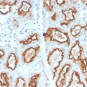 Formalin-fixed paraffin-embedded human Renal Cell Carcinoma Stained with RCC Rabbit Recombinant Monoclonal Antibody (CA9/2993R).