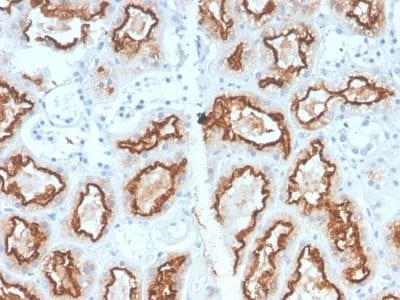 Formalin-fixed paraffin-embedded human Renal Cell Carcinoma Stained with RCC Rabbit Recombinant Monoclonal Antibody (CA9/2993R).