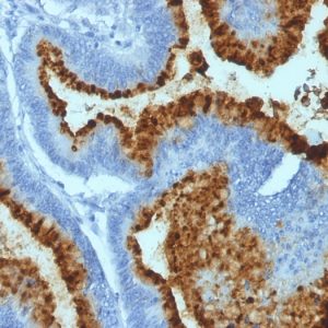 Formalin-fixed, paraffin-embedded human Colon Carcinoma stained with Blood Group B Monoclonal Antibody (HEB-20).