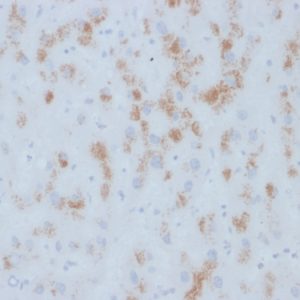 Formalin-fixed, paraffin-embedded human Hepatic Carcinoma stained with Cytochrome p450 Mouse Monoclonal Antibody (M12P4H2).