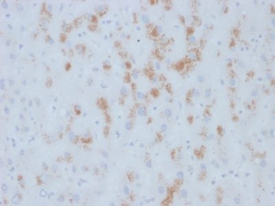 Formalin-fixed, paraffin-embedded human Hepatic Carcinoma stained with Cytochrome p450 Mouse Monoclonal Antibody (M12P4H2).