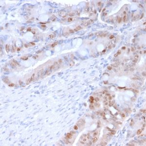 Formalin-fixed, paraffin-embedded human Colon Carcinoma stained with PCNA Mouse Monoclonal Antibody (PC5).