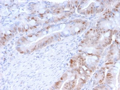 Formalin-fixed, paraffin-embedded human Colon Carcinoma stained with PCNA Mouse Monoclonal Antibody (PC5).