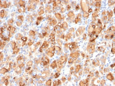 Formalin-fixed, paraffin-embedded human Thyroid stained with Thyroglobulin Mouse Recombinant Monoclonal Antibody (r2H11).