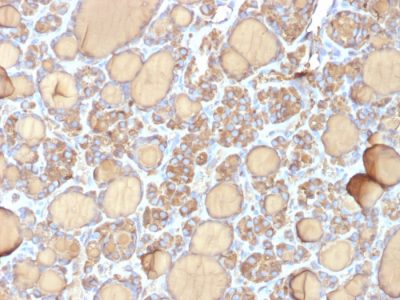 Formalin-fixed, paraffin-embedded human Thyroid stained with Thyroglobulin Mouse Recombinant Monoclonal Antibody (r6E1).