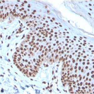Formalin-fixed, paraffin-embedded human Basal Cell Carcinoma stained with Histone H1 Mouse Recombinant Monoclonal Antibody (rAE-4).