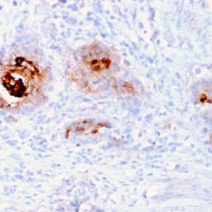Formalin-fixed, paraffin-embedded human Breast Carcinoma stained with TAG-72 Recombinant Mouse Monoclonal Antibody (rB72.3).