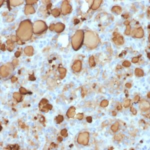 Formalin-fixed, paraffin-embedded human Thyroid Carcinoma stained with Thyroglobulin Mouse Recombinant Monoclonal Antibody (rTGB24).