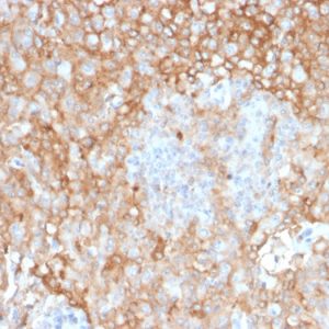 Formalin-fixed, paraffin-embedded human Lung Tumor stained with HLA-DR Mouse Monoclonal Antibody (TAL 1B5).