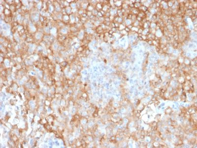 Formalin-fixed, paraffin-embedded human Lung Tumor stained with HLA-DR Mouse Monoclonal Antibody (TAL 1B5).