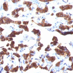 Formalin-fixed, paraffin-embedded human Thyroid Carcinoma stained Thyroglobulin Mouse Monoclonal Antibody (TGB24).
