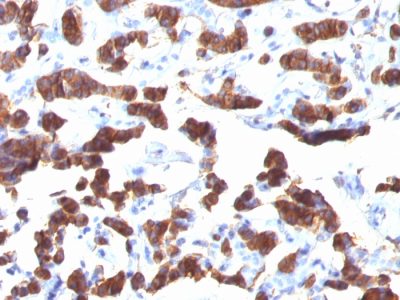 Formalin-fixed, paraffin-embedded human Thyroid Carcinoma stained Thyroglobulin Mouse Monoclonal Antibody (TGB24).