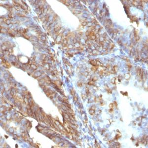 Formalin-fixed, paraffin-embedded human Uterine Carcinoma stained with Vimentin Mouse Monoclonal Antibody (V9).