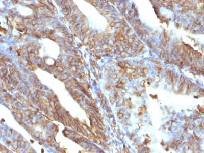 Formalin-fixed, paraffin-embedded human Uterine Carcinoma stained with Vimentin Mouse Monoclonal Antibody (V9).